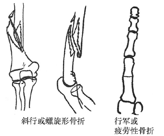 撕脫或劈裂骨折;螺旋形骨折青枝骨折嵌入骨折;縱行骨折;疲勞骨折粉碎