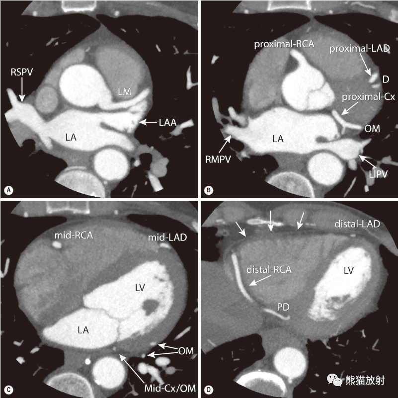 冠状动脉ct:相关概念,解剖……大盘点!