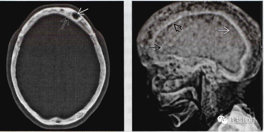 颅骨纤维结构不良,paget病丨影像诊断相关要点_医学界