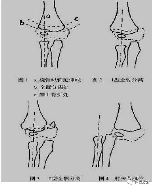 骨骺损伤的分型及影像表现_医学界-助力医生临床决策和职业成长
