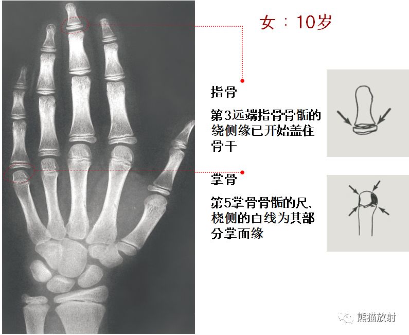 务必收藏丨最全骨龄图谱!