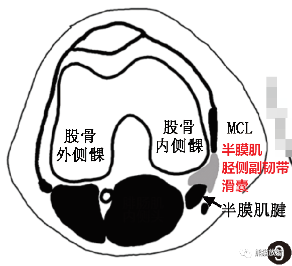 灰色区域,红字为相应名称)膝外侧区滑囊:图10-12膝内侧区滑囊:图6-9膝