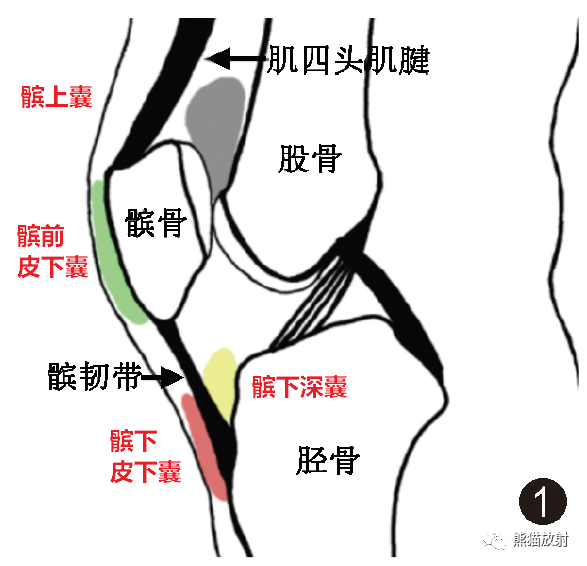 5膝前区滑囊:图1膝关节周围滑囊根据解剖位置可分为4组:滑囊:即滑膜囊