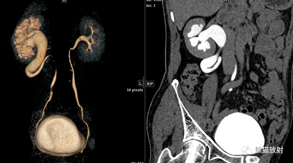 circumcaval ureter8215 腔静脉后输尿管诊断:行ivp,ctu检查男性
