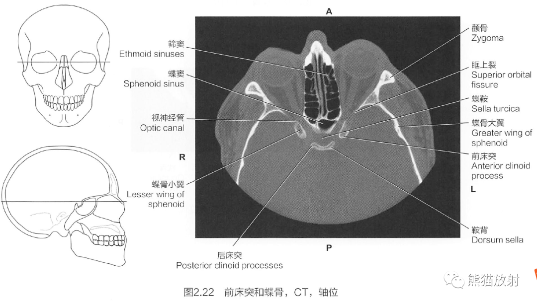 蝶骨三维图图片