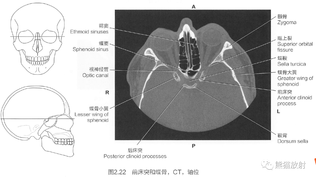 断解选读丨脑颅之蝶骨,枕骨_医学界-助力医生临床决策和职业成长