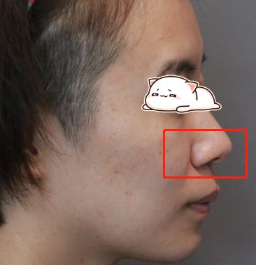 8203医生我鼻翼这么大给我做缩小吧