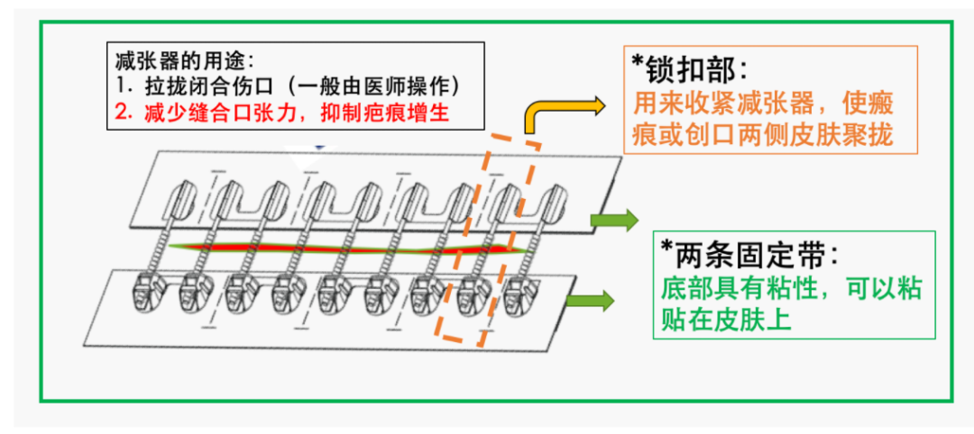 医用缝合扣怎么用瘢痕防治新武器-皮肤减张缝合器_https://www.jmylbn.com_新闻资讯_第3张
