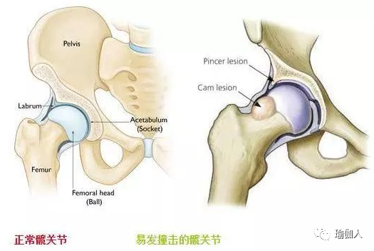 最容易被忽視的髖部疼痛疾病——髖關節撞擊綜合症 健康 第1張