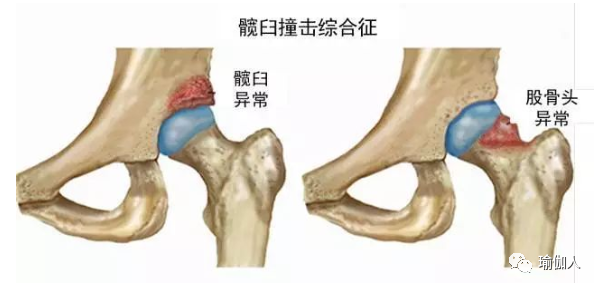 最容易被忽視的髖部疼痛疾病——髖關節撞擊綜合症 健康 第2張