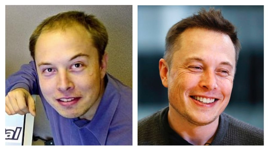 疤痕性体质抠了结痂_头皮结痂又抠掉又结痂怎么治_头皮结痂反复抠几年了