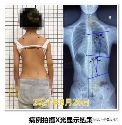 3D打印脊柱侧弯矫形器的图7