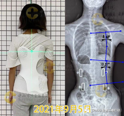 3D打印脊柱侧弯矫形器的图14
