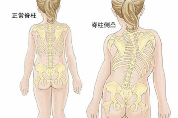3D打印脊柱侧弯矫形器的图2