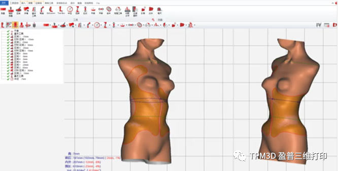 3D打印脊柱侧弯矫形器的图9