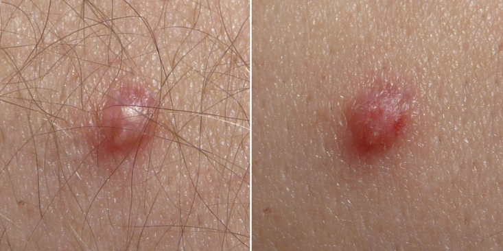 刮匙怎么使用HPV疫苗打完就安全了吗？男生要打吗？几岁打最有用？一文讲清_https://www.jmylbn.com_新闻资讯_第3张