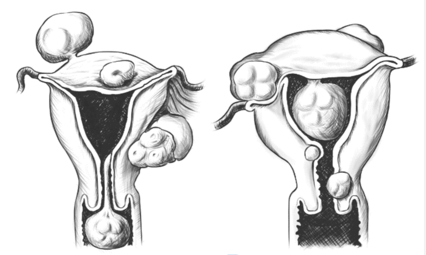 微乔线是什么从妇产科四类常见手术，一窥倒刺线的“神奇”助力_https://www.jmylbn.com_新闻资讯_第3张