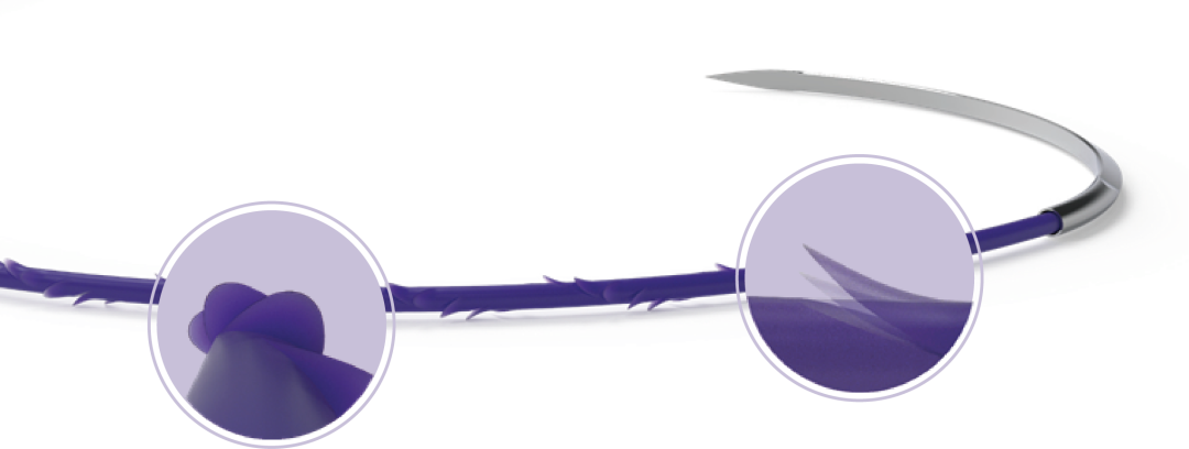 微乔线是什么从妇产科四类常见手术，一窥倒刺线的“神奇”助力_https://www.jmylbn.com_新闻资讯_第1张