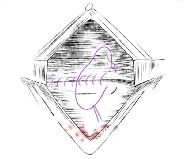 微乔线是什么从妇产科四类常见手术，一窥倒刺线的“神奇”助力_https://www.jmylbn.com_新闻资讯_第2张