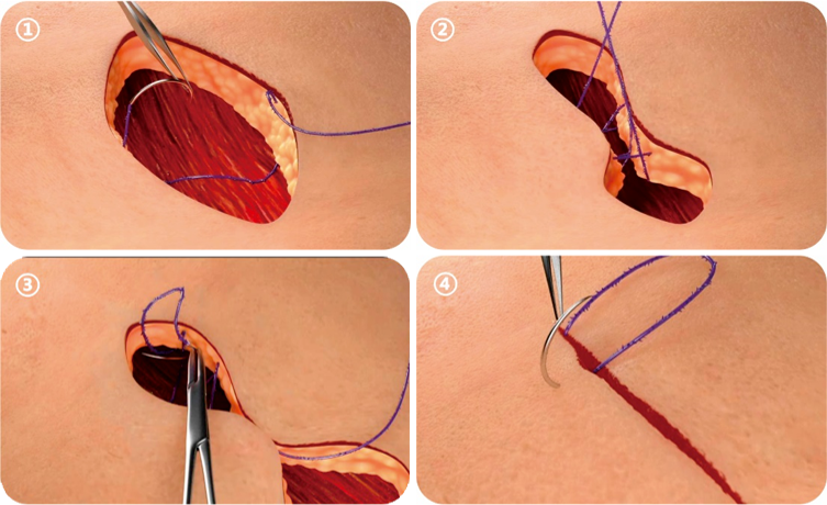 倒刺线怎么缝合泌尿外科微创时代，看倒刺线如何大显身手_https://www.jmylbn.com_新闻资讯_第4张
