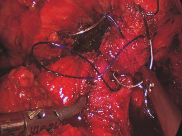 倒刺线怎么缝合泌尿外科微创时代，看倒刺线如何大显身手_https://www.jmylbn.com_新闻资讯_第3张