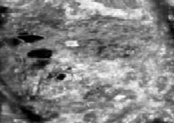 什么是超声容积探头自动乳腺容积超声技术专家共识（2022版）重点摘要_https://www.jmylbn.com_新闻资讯_第12张