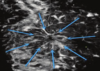 什么是超声容积探头自动乳腺容积超声技术专家共识（2022版）重点摘要_https://www.jmylbn.com_新闻资讯_第8张