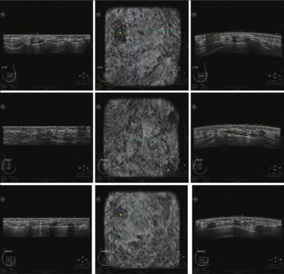 什么是超声容积探头自动乳腺容积超声技术专家共识（2022版）重点摘要_https://www.jmylbn.com_新闻资讯_第20张