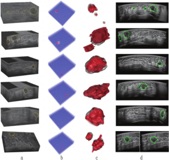 什么是超声容积探头自动乳腺容积超声技术专家共识（2022版）重点摘要_https://www.jmylbn.com_新闻资讯_第22张