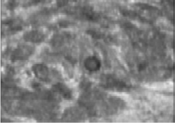 什么是超声容积探头自动乳腺容积超声技术专家共识（2022版）重点摘要_https://www.jmylbn.com_新闻资讯_第11张