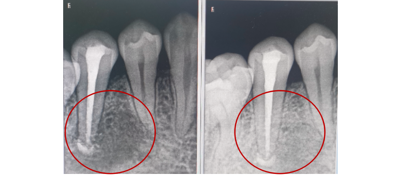 什么是显微镜手术什么是显微根尖囊肿手术？_https://www.jmylbn.com_新闻资讯_第7张