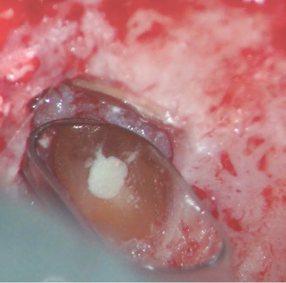 什么是显微镜手术什么是显微根尖囊肿手术？_https://www.jmylbn.com_新闻资讯_第3张