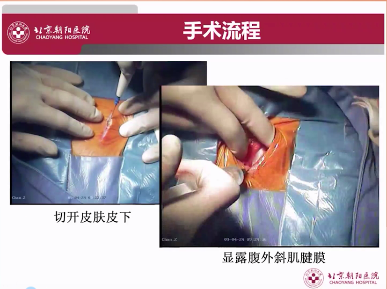 s拉钩怎么用拉钩好几年，还是搞不懂腹股沟区的解剖层次？_https://www.jmylbn.com_新闻资讯_第7张