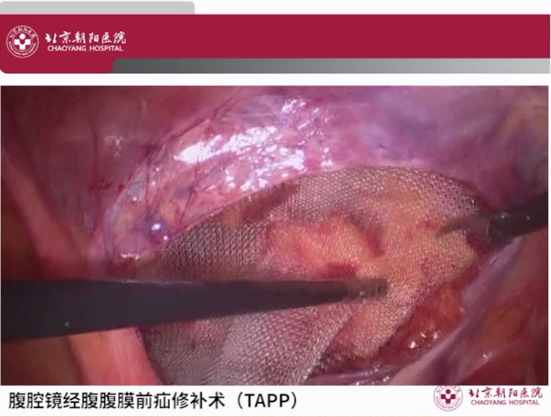 s拉钩怎么用拉钩好几年，还是搞不懂腹股沟区的解剖层次？_https://www.jmylbn.com_新闻资讯_第8张