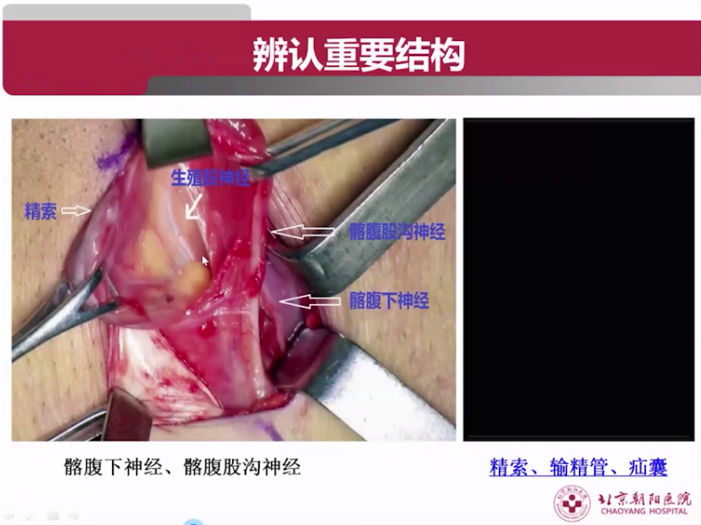 s拉钩怎么用拉钩好几年，还是搞不懂腹股沟区的解剖层次？_https://www.jmylbn.com_新闻资讯_第5张