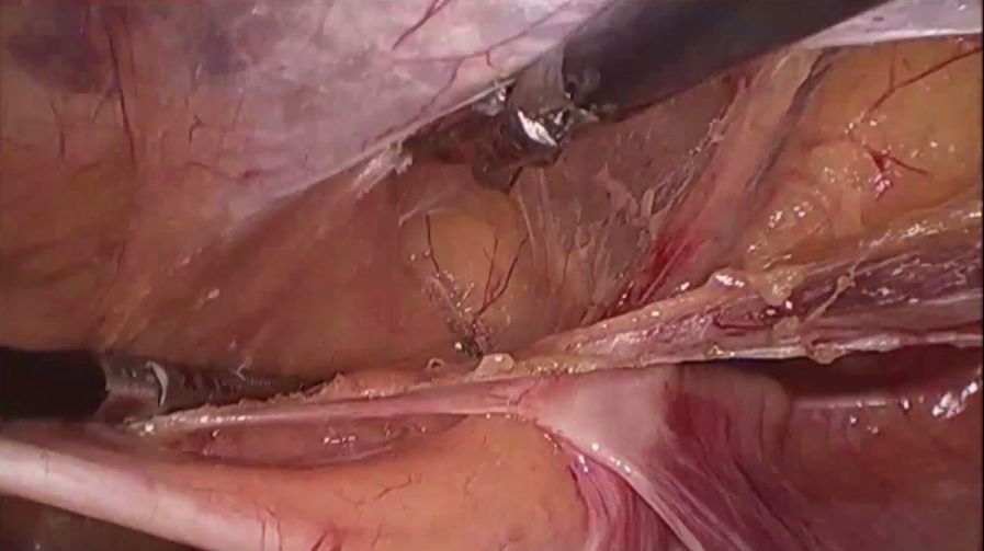 s拉钩怎么用拉钩好几年，还是搞不懂腹股沟区的解剖层次？_https://www.jmylbn.com_新闻资讯_第9张