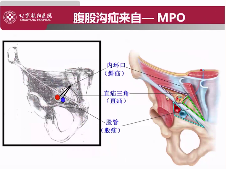 s拉钩怎么用拉钩好几年，还是搞不懂腹股沟区的解剖层次？_https://www.jmylbn.com_新闻资讯_第4张