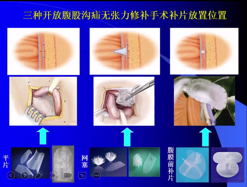 s拉钩怎么用拉钩好几年，还是搞不懂腹股沟区的解剖层次？_https://www.jmylbn.com_新闻资讯_第15张