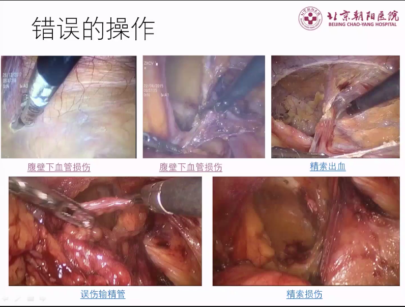 s拉钩怎么用拉钩好几年，还是搞不懂腹股沟区的解剖层次？_https://www.jmylbn.com_新闻资讯_第11张