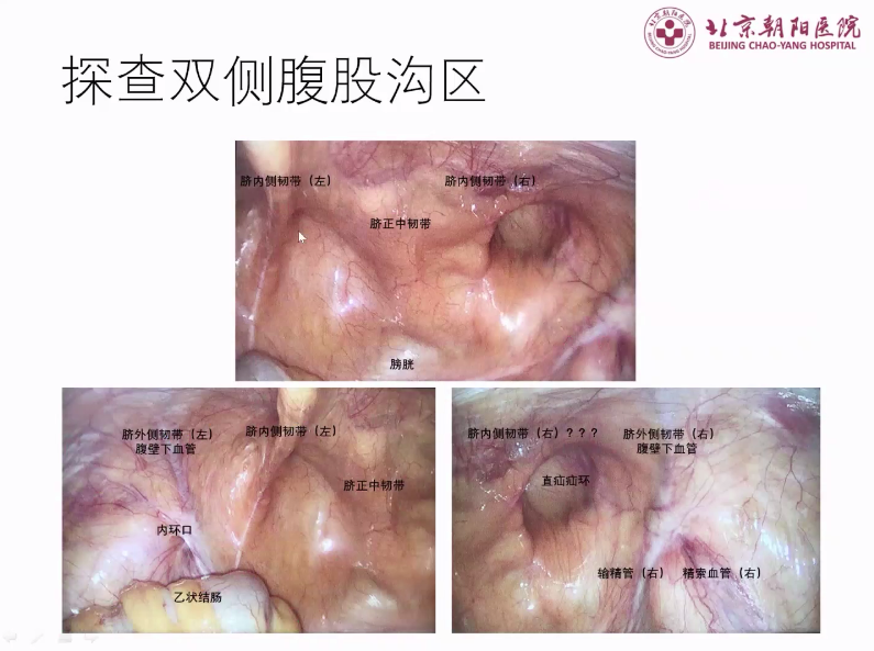 s拉钩怎么用拉钩好几年，还是搞不懂腹股沟区的解剖层次？_https://www.jmylbn.com_新闻资讯_第6张