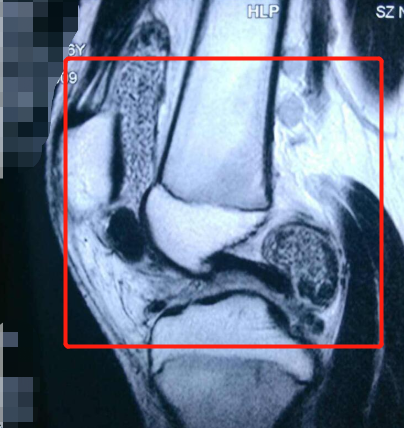 滑膜炎积液如何治疗？一文讲透，附解决方法