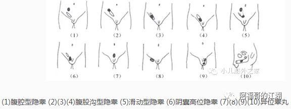 但随着婴儿的生长发育,到1岁时隐睾的发生率为0