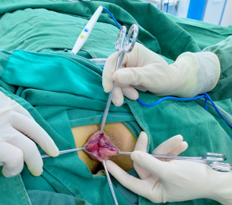 痔疮吻合器怎么使用有“痔”之士的福音—吻合器痔上粘膜环切术（PPH）_https://www.jmylbn.com_新闻资讯_第3张