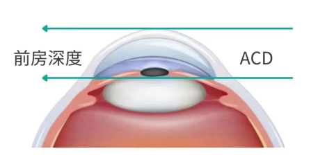 眼科生物测量仪怎么看近视防控必备—生物测量仪（查眼轴）怎么用？_https://www.jmylbn.com_新闻资讯_第3张