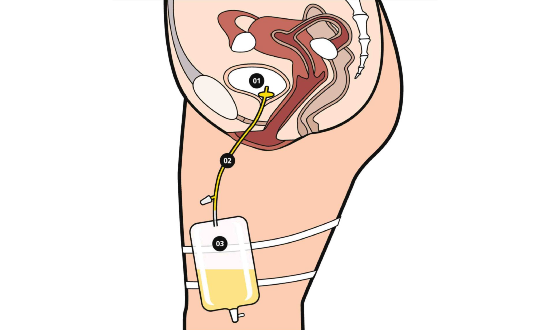怎么使用集尿袋“石”话实说 ｜ 泉小护健康课堂第八十六期——常用留置导管居家护理规范之导尿管_https://www.jmylbn.com_新闻资讯_第9张