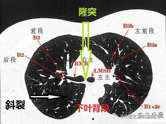 結合解剖看胸部ct輕鬆掌握肺段分佈及重要血管