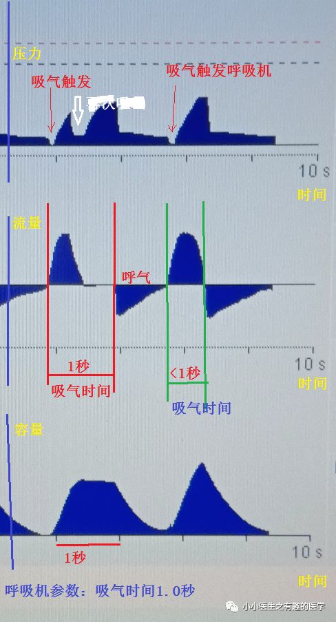 呼吸机ac是什么意思呼吸机：SIMV与AC模式的区别，不讲区别的都是耍流氓_https://www.jmylbn.com_新闻资讯_第5张