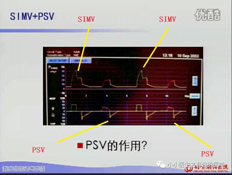 呼吸机ac是什么意思呼吸机：SIMV与AC模式的区别，不讲区别的都是耍流氓_https://www.jmylbn.com_新闻资讯_第16张