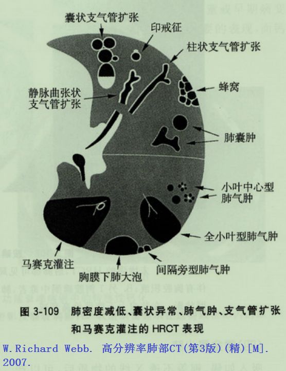 肺大泡肺气肿肺气囊囊肿空洞ct如何鉴别