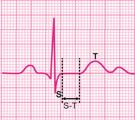 心电图纸怎么看心电图纸上跳动的线条，你了解多少？_https://www.jmylbn.com_新闻资讯_第14张